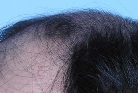 男性防止脱发需要每天洗头吗