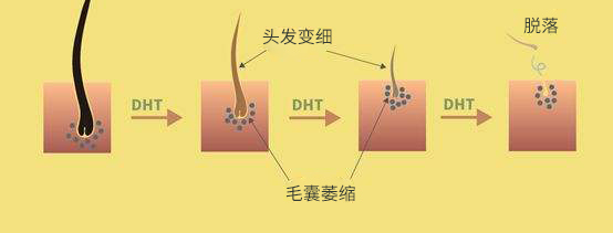 为什么脱发钟爱男性?