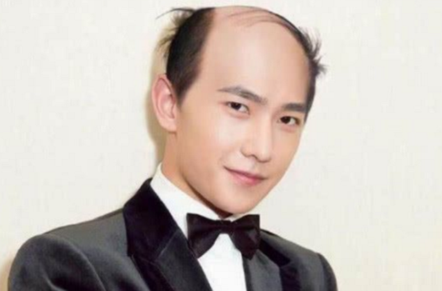  男性脱发变成“地中海”都有什么原因