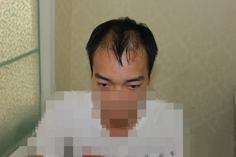 植发方案设计