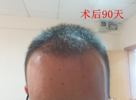 植发后3个月