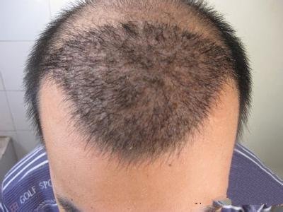 男性脱发：发际线两侧额角怎么生发