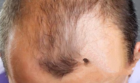 男性脱发都应该使用哪些有效的方法治疗?　