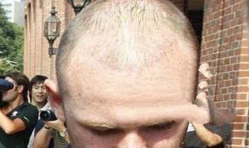 治疗男性脱发都有哪些常见的方法呢？