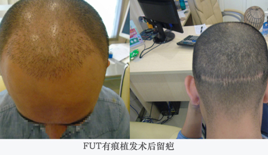 有痕植发术后留疤.jpg 有痕植发术后留疤.jpg
