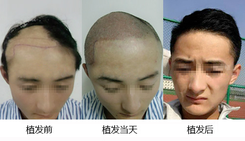 植发.jpg 植发.jpg